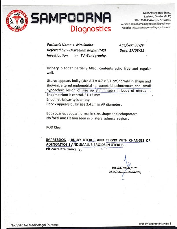 Uterine fibroid, curd with history of thyphoid and jaundice, a Case study.  - Image 1