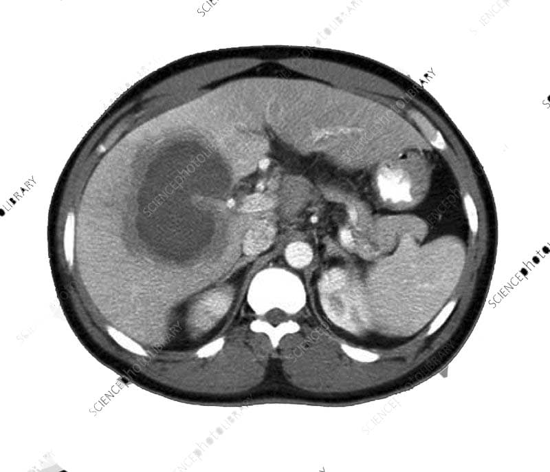Liver Abscess, complicated with acute renal failure, Cured by Homeopathy: A Case Study