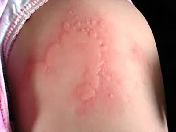 Urticaria a long-standing case: with the history of epilepsy cured by Pulsatilla.