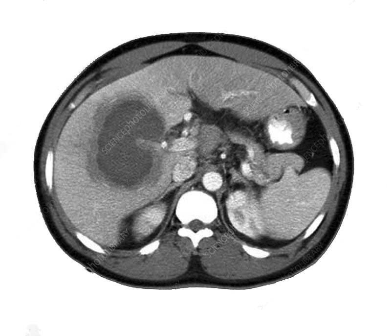 Liver Abscess, complicated with acute renal failure, Cured by Homeopathy: A Case Study