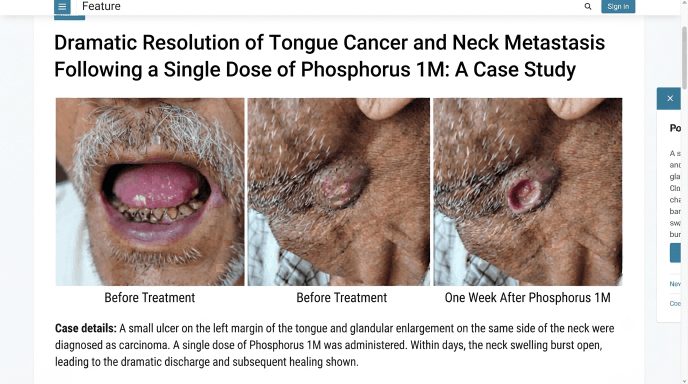 Phosphorus as a Remedy in Tongue Cancer: A Case Study